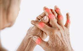 Managing Arthritis: Pain Relief and Lifestyle Changes